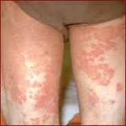Skin disease from Molds<br />
