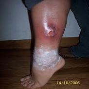 Mold5 Mold Infection<br />